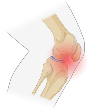 Knee Pain